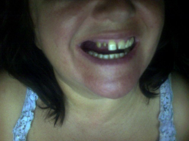 Implant