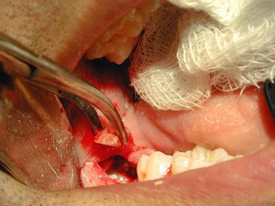 Wisdom Teeth Removal And Costs For Removal